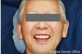 歯科医師による入れ歯の試適