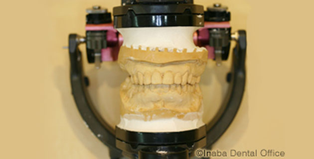 診断用歯列模型の完成です。噛み合わせに関する多くの情報が得られます。
