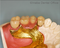 保険適用のレジン床と金属床義歯の厚みの比較