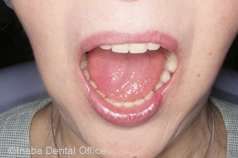 「上下顎同時印象法」で総入れ歯を作製した患者様。口を大きくあけても浮き上がりません