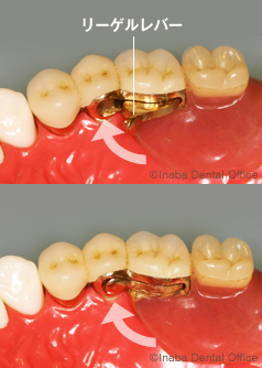 入れ歯の内側のリーゲルレバーを閉めると入れ歯は固定され外れなくなります