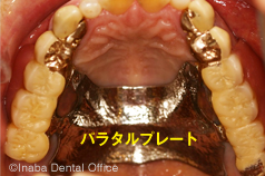 義歯が安定するのでパラタルプレートの面積も小さくできます