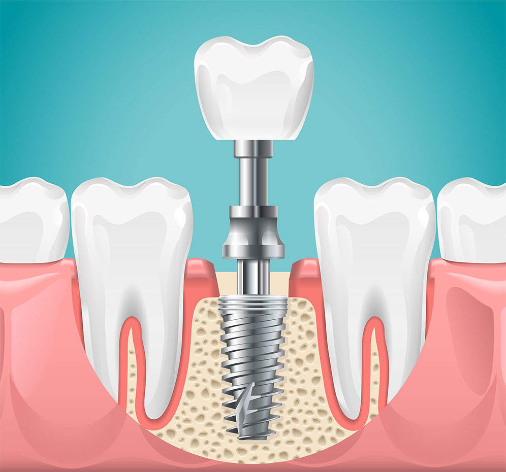 インプラント治療と入れ歯の組み合わせ治療について