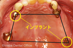 4点支持を作るため、○印の部位にインプラントを埋入しました