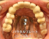 当院で使用する金属の板（パラタルプレート）は、違和感を覚えにくい特殊な型です