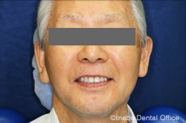 歯科医師による完成義歯の確認、装着