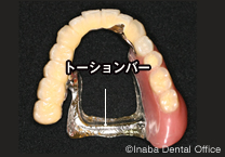 発音と味覚重視の部分入れ歯「トーションバー」