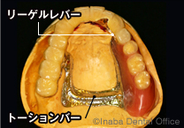 その上にリーゲルレバーつきのトーションバーを用いた入れ歯を被せます