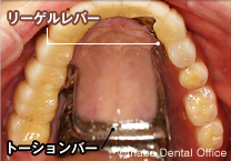 口蓋部を覆う面積を小さくできます
