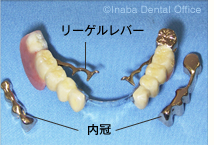 リンガルバー